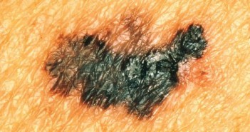 Na zdjęciu znajduje się czerniak złośliwy. Dzięki technologii obrazowania hiperspektralnego, określenie jego dokładnego wymiaru i kształtów zostanie znacznie ułatwione, co zmniejszy ilość błędów lekarskich w jego wykrywaniu i usuwaniu. Może to być potrzebne w trakcie załogowych misji kosmicznych, gdzie astronauci pozbawieni będą ochronnej powłoki atmosfery ziemskiej - na przykład na powierzchni Marsa. (Źródło: U.S. National Institutes of Health)
