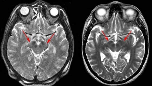 Po lewej: Obraz mózgowia pacjenta z chorobą Parkinsona. Strzałki wskazują na charakterystyczne dla schorzenia zwężenie istoty zbitej substancji czarnej. Po prawej: obraz mózgu zdrowego człowieka w tym samym wieku. Nanotechniki opracowane przez naukowców Centrum Amesa mogą pomóc w lepszym poznaniu mechanizmów tej choroby. Credits: University of Virginia